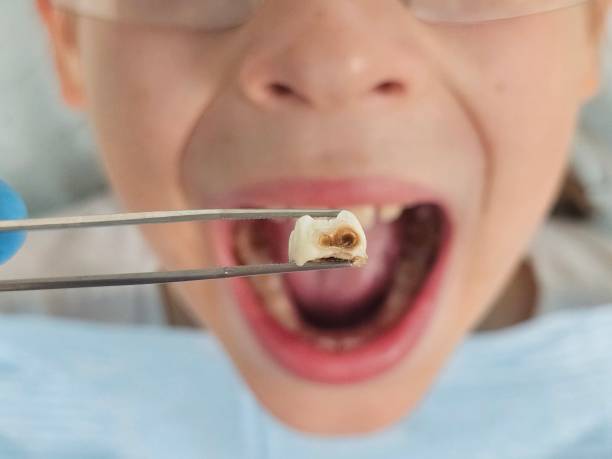 Best Emergency Tooth Extraction in Mercer, PA